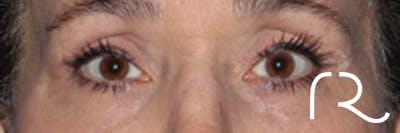Eyelid Surgery Before & After Gallery - Patient 248201 - Image 2