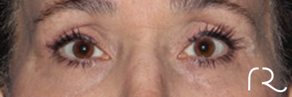Eyelid Surgery Before & After Gallery - Patient 248201 - Image 2