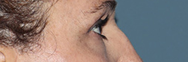 Eyelid Surgery Before & After Gallery - Patient 248201 - Image 6