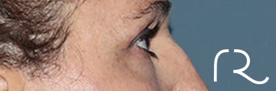 Eyelid Surgery Before & After Gallery - Patient 248201 - Image 6