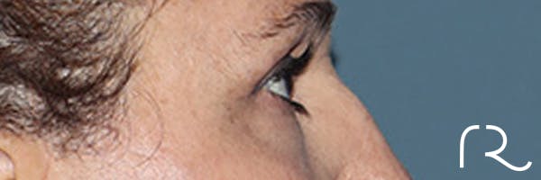 Eyelid Surgery Before & After Gallery - Patient 248201 - Image 6
