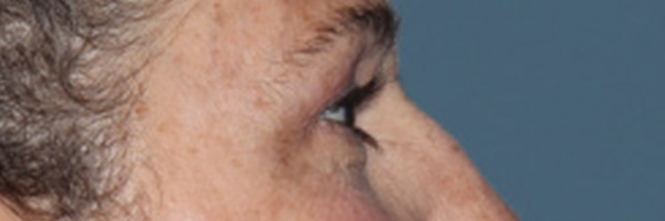 Eyelid Surgery Before & After Gallery - Patient 248201 - Image 5