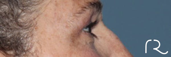Eyelid Surgery Before & After Gallery - Patient 248201 - Image 5