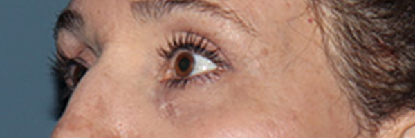 Eyelid Surgery Before & After Gallery - Patient 248201 - Image 4