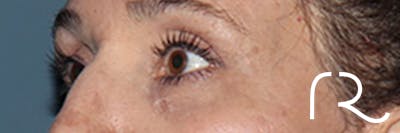 Eyelid Surgery Before & After Gallery - Patient 248201 - Image 4