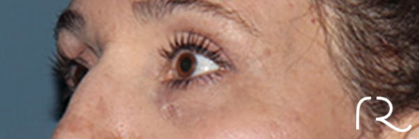 Eyelid Surgery Before & After Gallery - Patient 248201 - Image 4