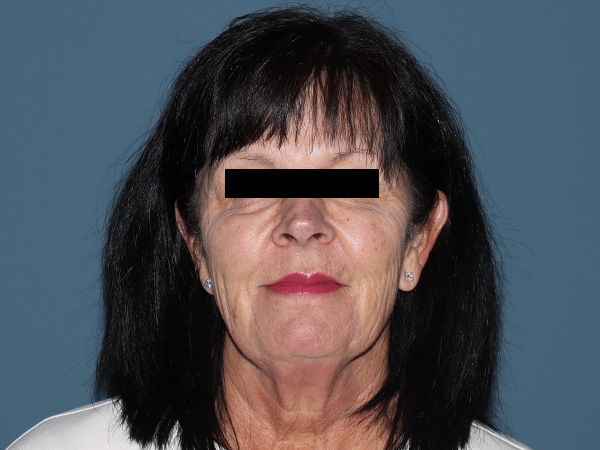 Fractional CO2 Laser Resurfacing Before & After Gallery - Patient 420942 - Image 1