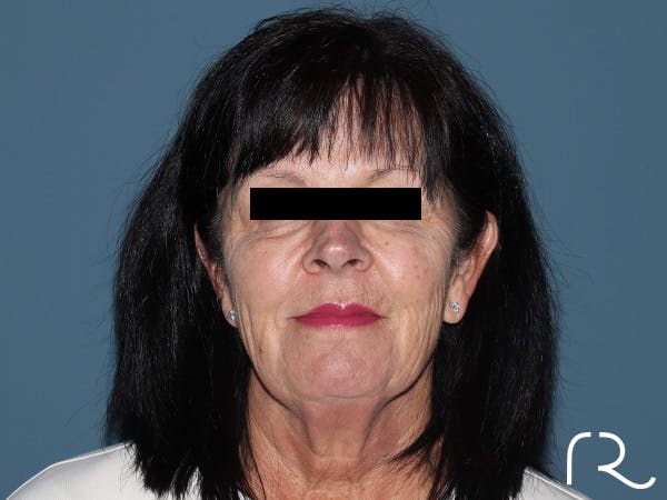 Fractional CO2 Laser Resurfacing Before & After Gallery - Patient 420942 - Image 1