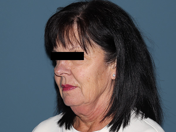 Facelift Before & After Gallery - Patient 261548 - Image 1