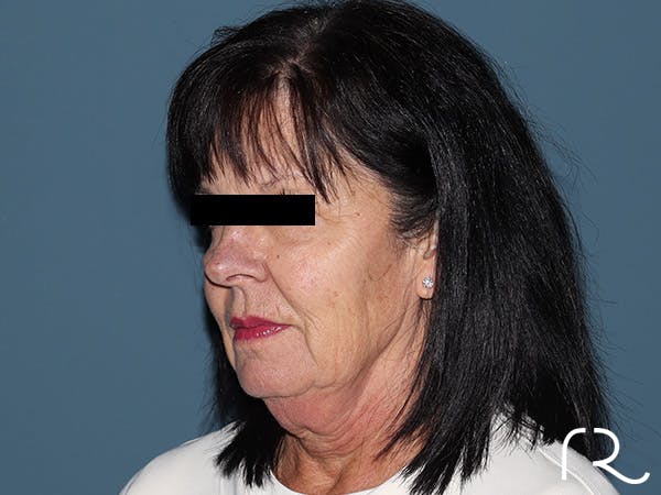 Fractional CO2 Laser Resurfacing Before & After Gallery - Patient 420942 - Image 3