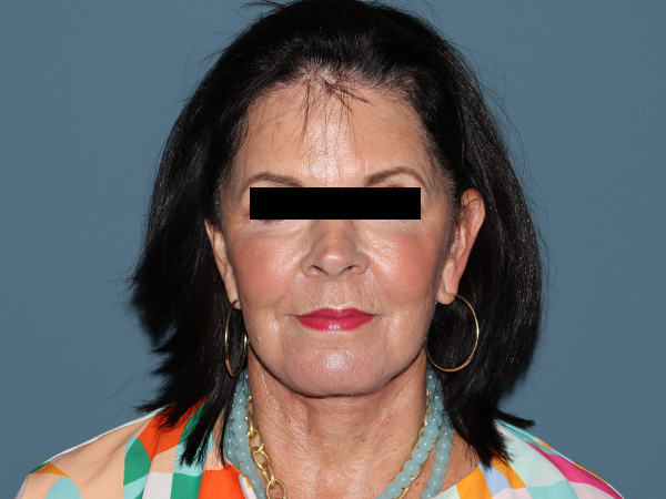 Fractional CO2 Laser Resurfacing Before & After Gallery - Patient 420942 - Image 2