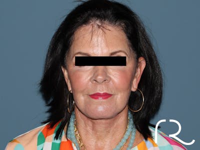 Fractional CO2 Laser Resurfacing Before & After Gallery - Patient 420942 - Image 2