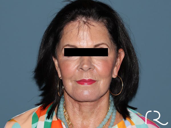 Fractional CO2 Laser Resurfacing Before & After Gallery - Patient 420942 - Image 2