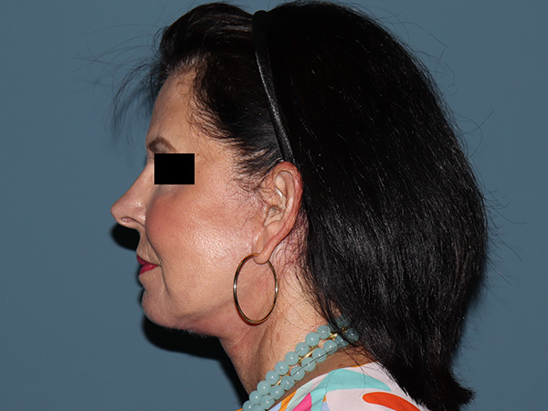 Fractional CO2 Laser Resurfacing Before & After Gallery - Patient 420942 - Image 6