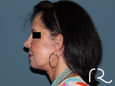 Fractional CO2 Laser Resurfacing Before & After Gallery - Patient 420942 - Image 6