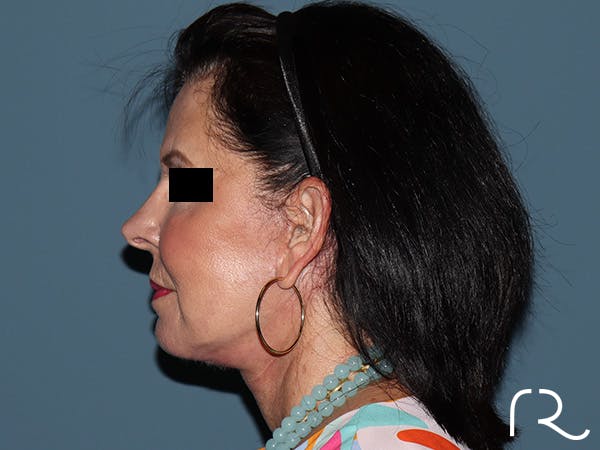 Fractional CO2 Laser Resurfacing Before & After Gallery - Patient 420942 - Image 6