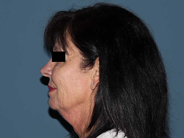 R2 Extended Deep Neck Lift Before & After Gallery - Patient 272453 - Image 1