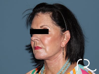 Fractional CO2 Laser Resurfacing Before & After Gallery - Patient 420942 - Image 4