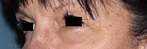 Eyelid Surgery Before & After Gallery - Patient 396442 - Image 3