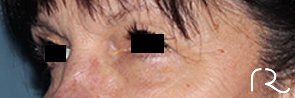 Eyelid Surgery Before & After Gallery - Patient 396442 - Image 3