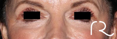 Eyelid Surgery Before & After Gallery - Patient 396442 - Image 2