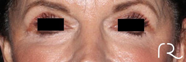 Eyelid Surgery Before & After Gallery - Patient 396442 - Image 2