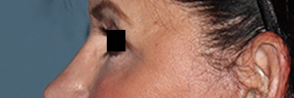 Eyelid Surgery Before & After Gallery - Patient 396442 - Image 6