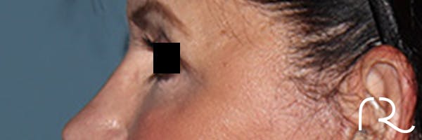 Eyelid Surgery Before & After Gallery - Patient 396442 - Image 6