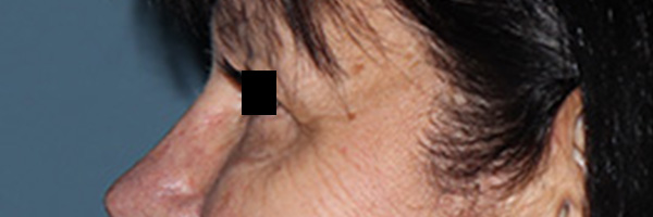 Eyelid Surgery Before & After Gallery - Patient 396442 - Image 5