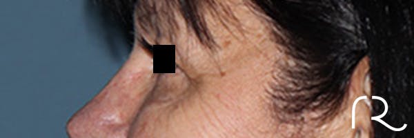 Eyelid Surgery Before & After Gallery - Patient 396442 - Image 5