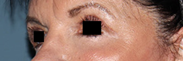 Eyelid Surgery Before & After Gallery - Patient 396442 - Image 4