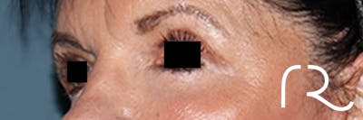 Eyelid Surgery Before & After Gallery - Patient 396442 - Image 4