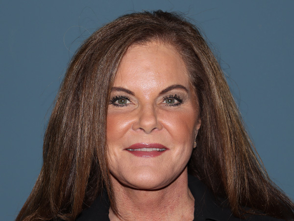 Facelift Before & After Gallery - Patient 134186 - Image 4