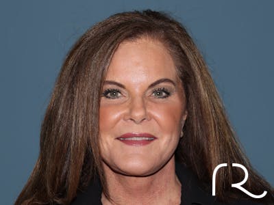 Facelift Before & After Gallery - Patient 134186 - Image 4