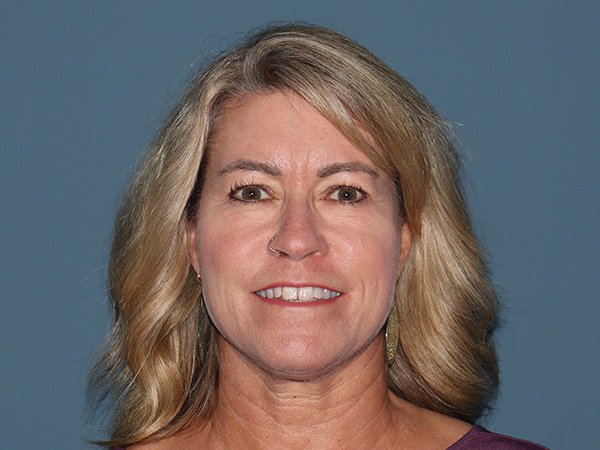 Fractional CO2 Laser Resurfacing Before & After Gallery - Patient 280825 - Image 1