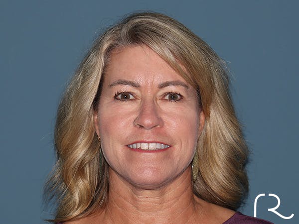 Fractional CO2 Laser Resurfacing Before & After Gallery - Patient 280825 - Image 1