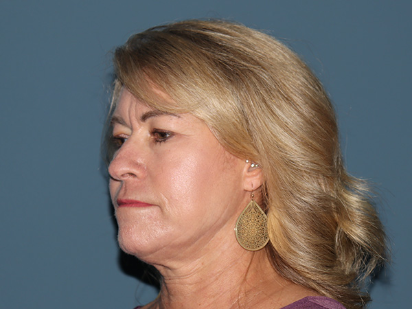 Facelift Before & After Gallery - Patient 255546 - Image 1