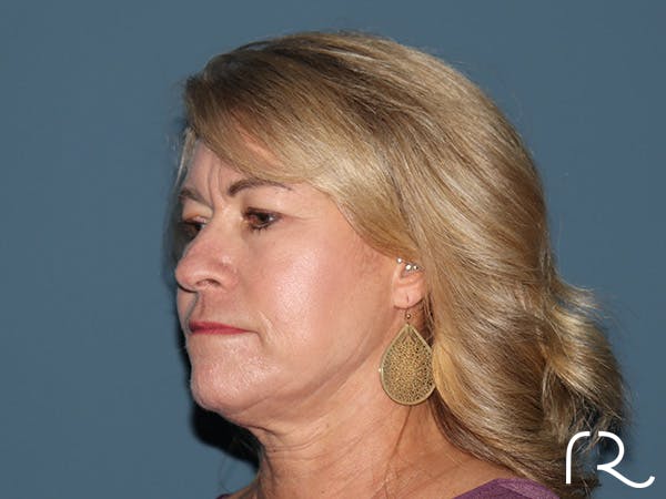 Fractional CO2 Laser Resurfacing Before & After Gallery - Patient 280825 - Image 3