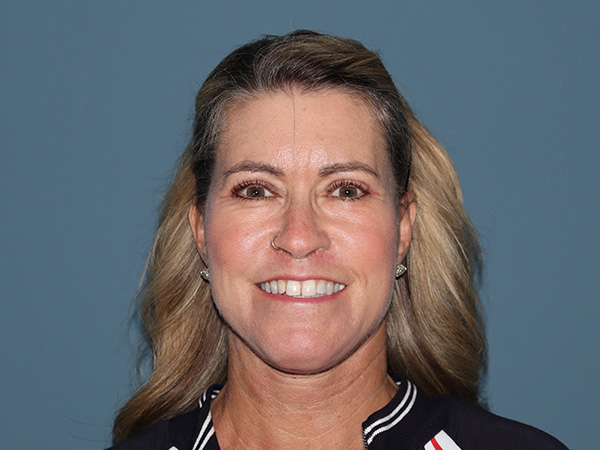 Fractional CO2 Laser Resurfacing Before & After Gallery - Patient 280825 - Image 2