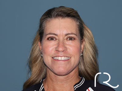 Fractional CO2 Laser Resurfacing Before & After Gallery - Patient 280825 - Image 2