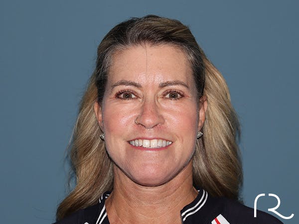 Fractional CO2 Laser Resurfacing Before & After Gallery - Patient 280825 - Image 2