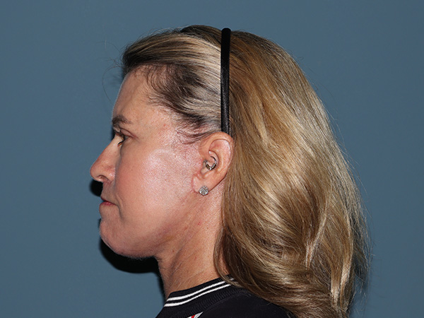 Fractional CO2 Laser Resurfacing Before & After Gallery - Patient 280825 - Image 6