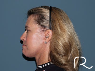 Fractional CO2 Laser Resurfacing Before & After Gallery - Patient 280825 - Image 6