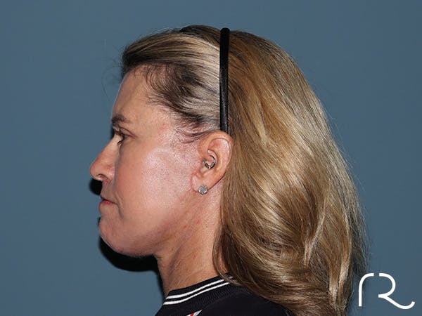 Fractional CO2 Laser Resurfacing Before & After Gallery - Patient 280825 - Image 6