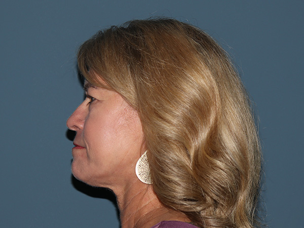 R2 Extended Deep Neck Lift Before & After Gallery - Patient 332713 - Image 1
