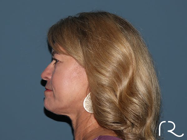 Fractional CO2 Laser Resurfacing Before & After Gallery - Patient 280825 - Image 5
