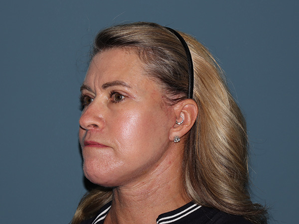 Fractional CO2 Laser Resurfacing Before & After Gallery - Patient 280825 - Image 4