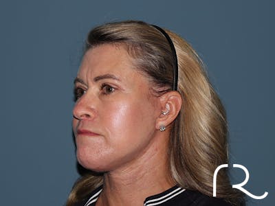 Fractional CO2 Laser Resurfacing Before & After Gallery - Patient 280825 - Image 4