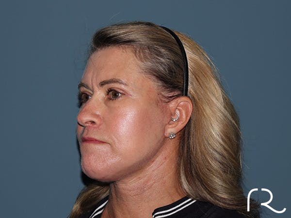 Fractional CO2 Laser Resurfacing Before & After Gallery - Patient 280825 - Image 4