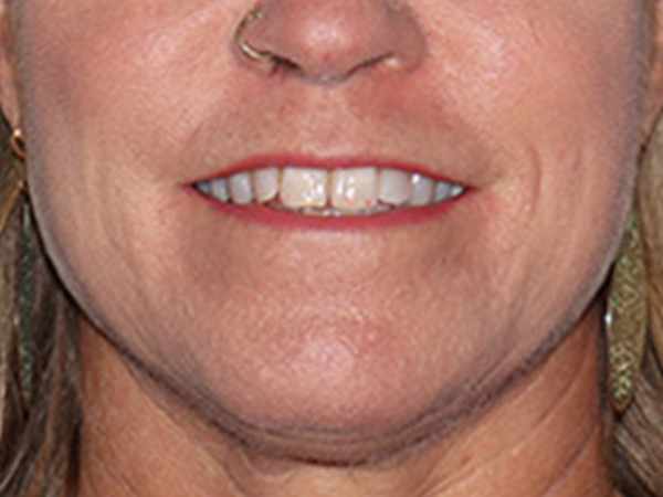 Lip Lift Before & After Gallery - Patient 155005 - Image 1